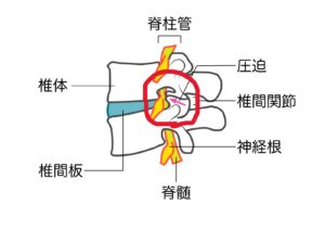 椎間関節症の原因は何ですか?