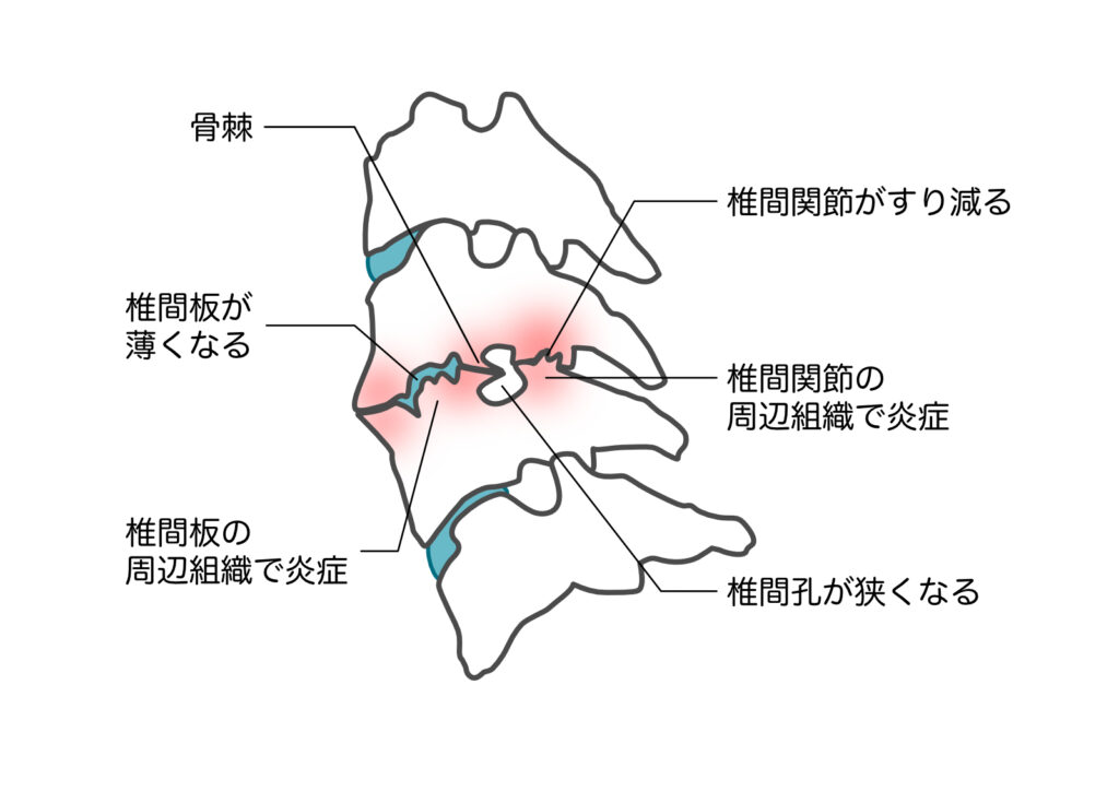 椎間関節症が他の症状を引き起こす可能性はありますか?